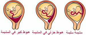 وضعيات نزول المشيمة