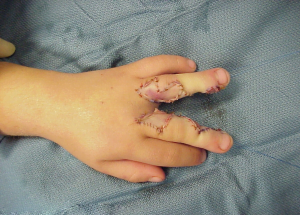 التدخل الجراحي لعلاج التصاق الأصابع