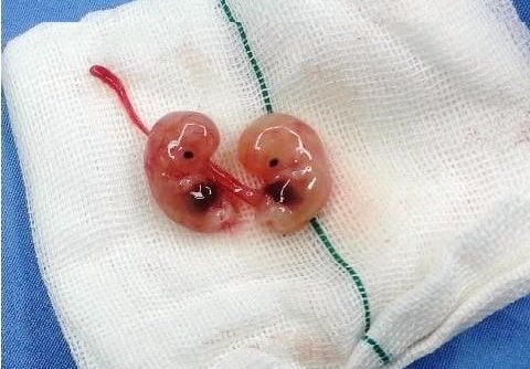 الإجهاض في الشهور الأولى