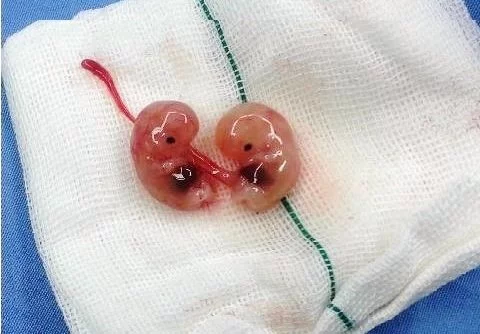 الإجهاض في الشهور الأولى