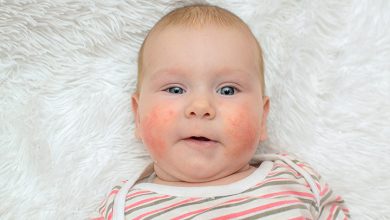 أعراض حساسية الألبان عند الرضع