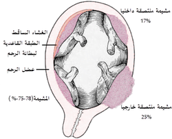 المشيمة الملتصقة
