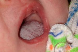 علاج فطريات الفم عند الرضع