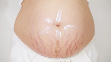 علامات التمدد أثناء الحمل