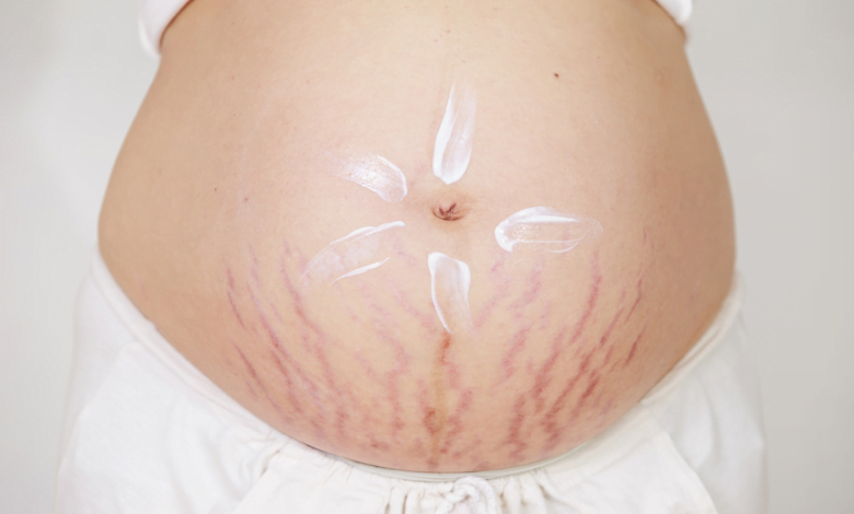 علامات التمدد أثناء الحمل