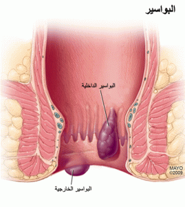 أنواع البواسير