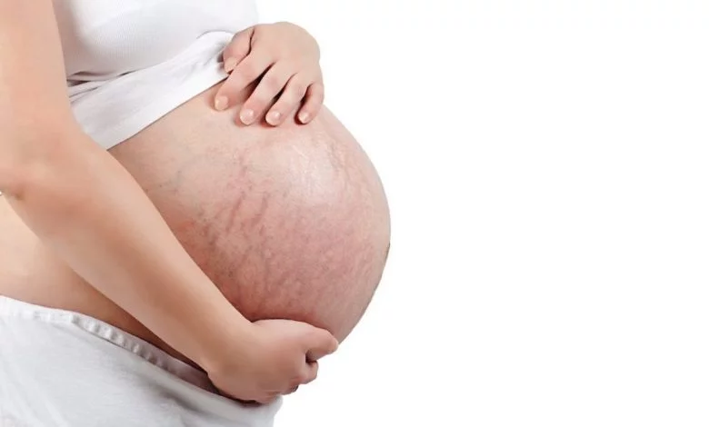 Treating Stretch Marks During and After Pregnancy
