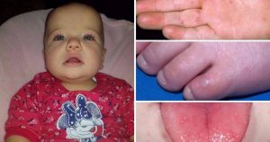متلازمة اليد والقدم والفم عند الرضع