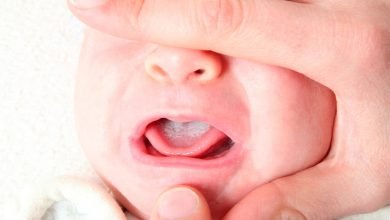 فطريات الفم عند حديثي الولادة